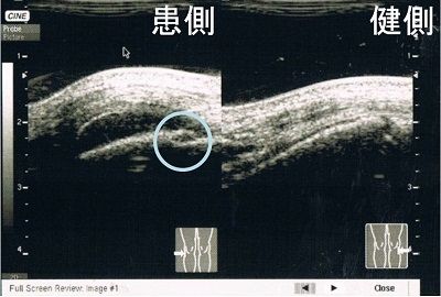 超音波画像