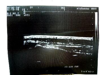 ギプス固定除去後超音波画像