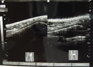 初診時超音波画像2