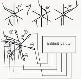 鍼通電破潰法