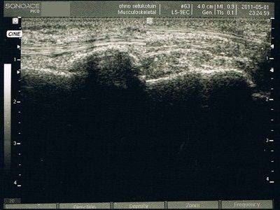 超音波画像（受傷直後）